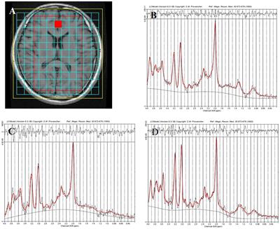 Neurochemical and microstructural alterations in bipolar and depressive disorders: A multimodal magnetic resonance imaging study